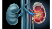 Kidney Stones